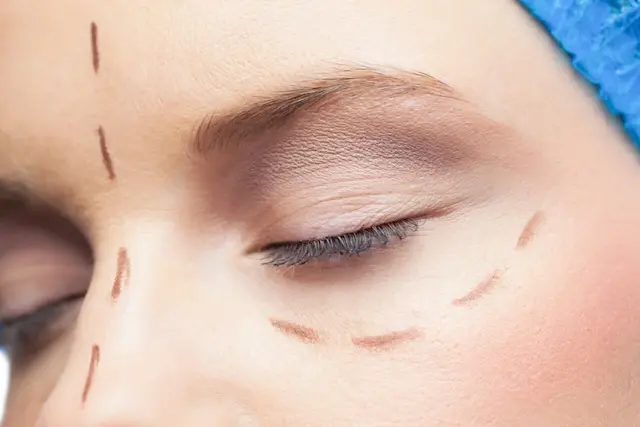 Blefaroplastia - Dr. Alan Rodr&iacute;guez