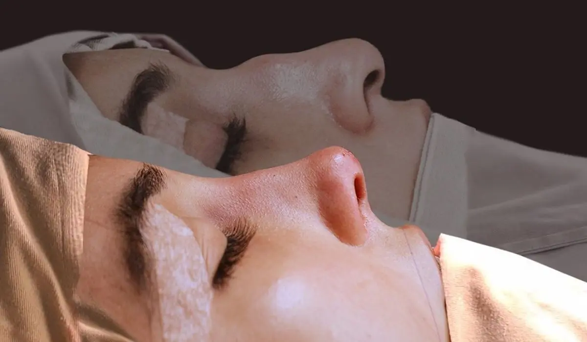 Rinoplastia Ultras&oacute;nica - Dr. Alan Rodr&iacute;guez