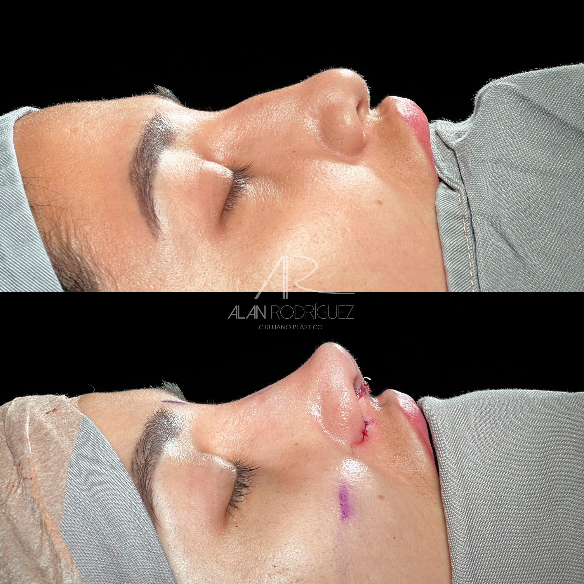 Rinoplastia Primaria en Barranquilla: Transformación Estructural y Resultados Naturales