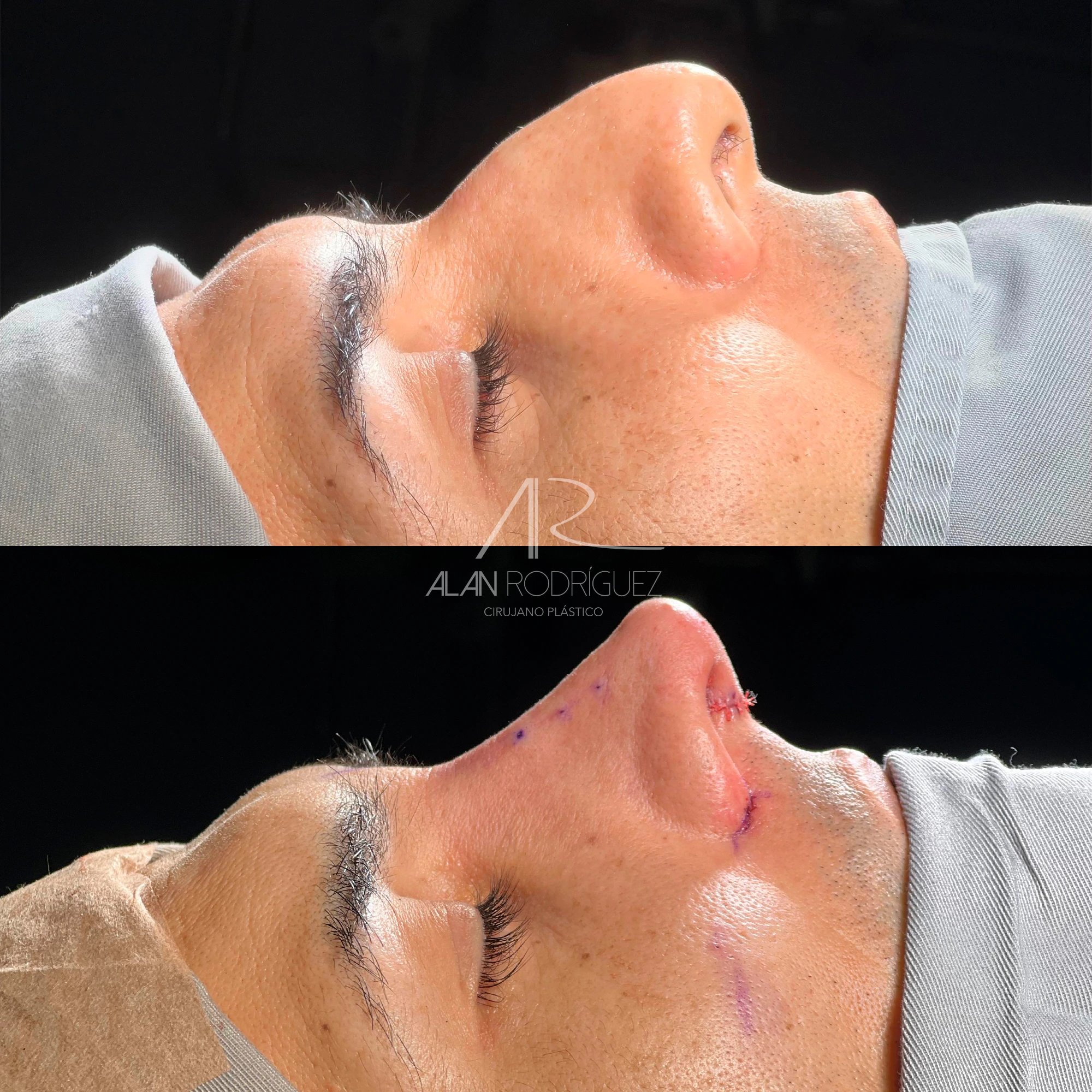 Rinoplastia Masculina en Barranquilla: Definición Nasal y Armonía Varonil