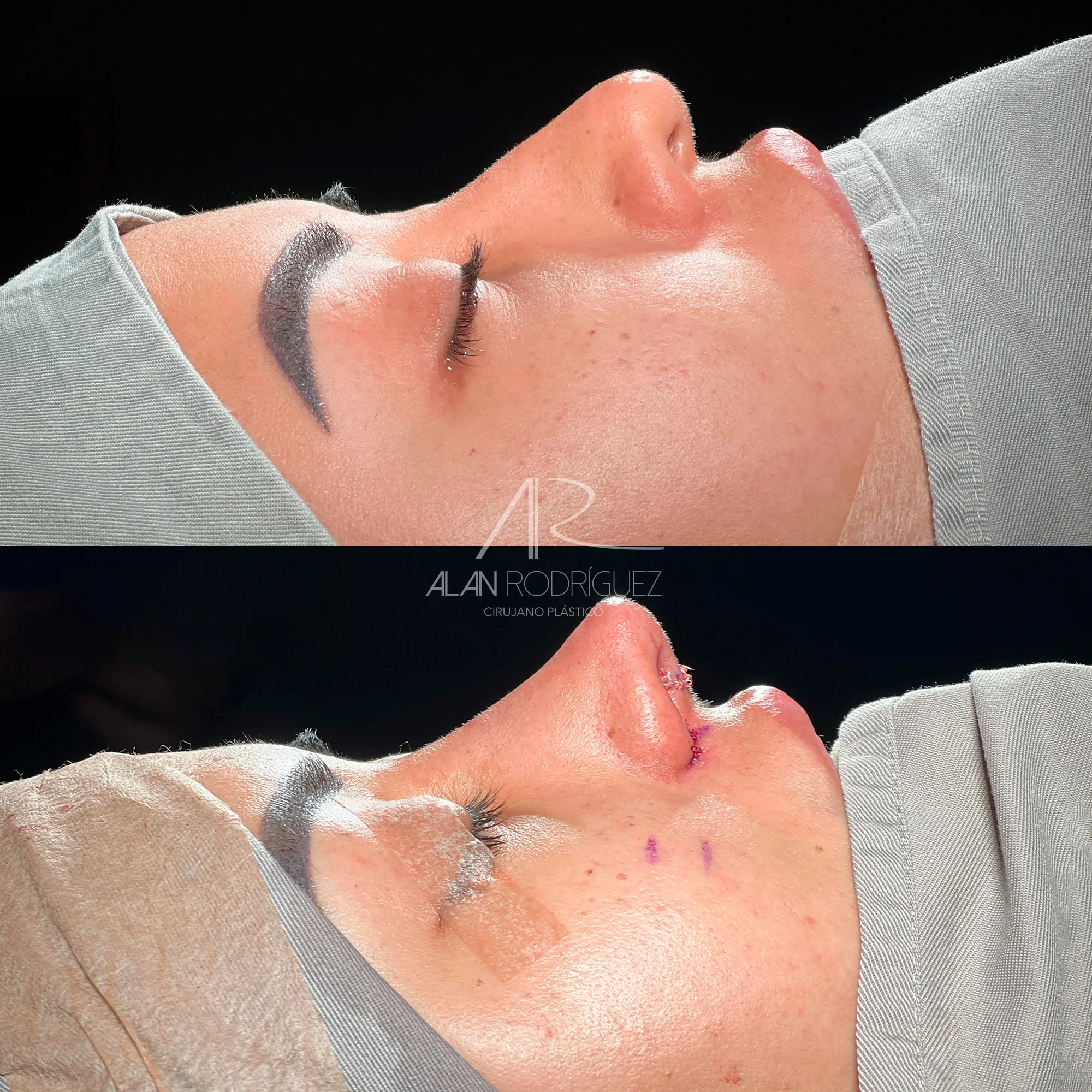 Rinoplastia de Refinamiento en Barranquilla: El Arte de la Proporción y Delicadeza