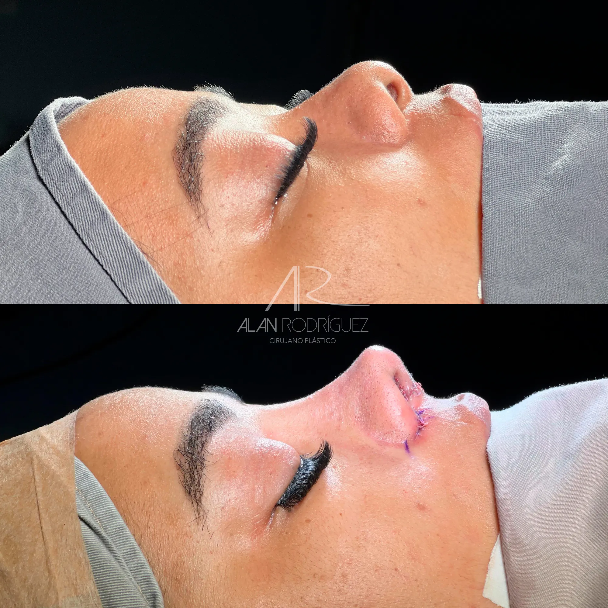 Rinoplastia Primaria en Caso Complejo: Corrección de Rinomodelación Previa