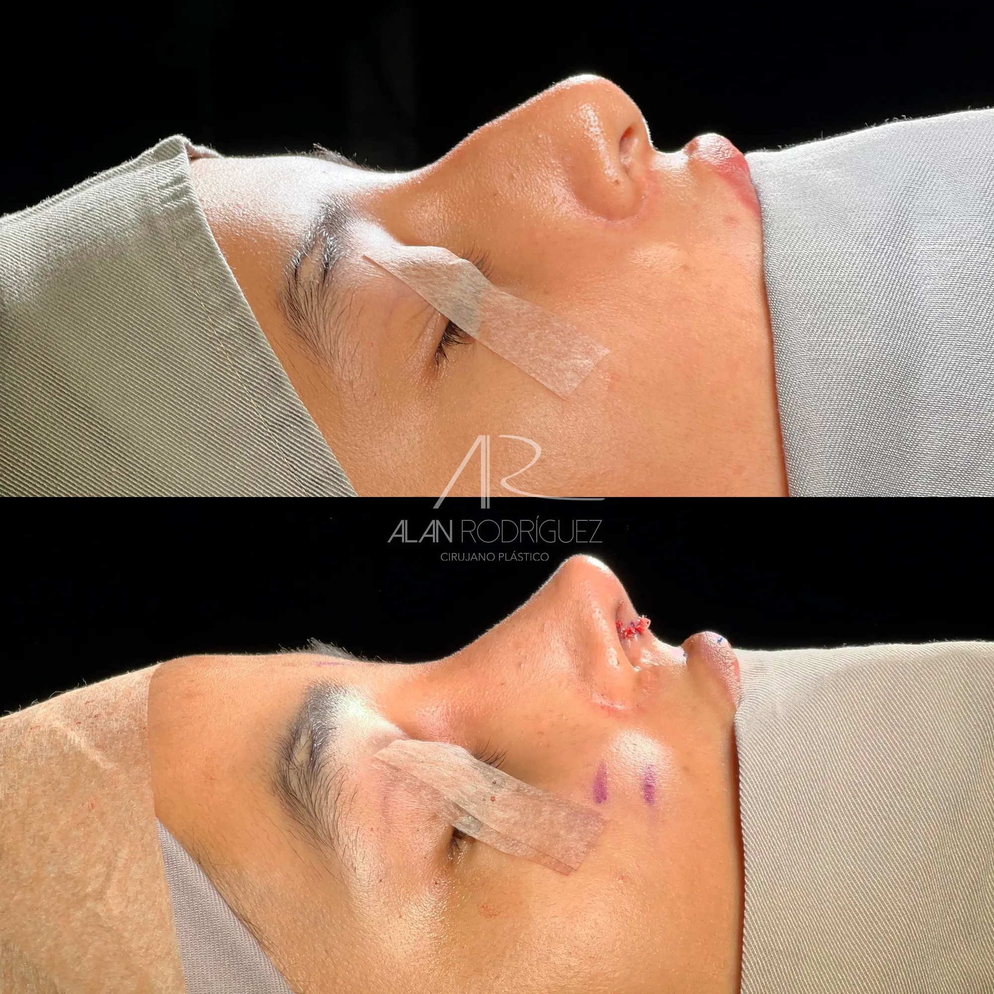 Rinoplastia Primaria: Corrección de Giba Dorsal y Desvío Nasal
