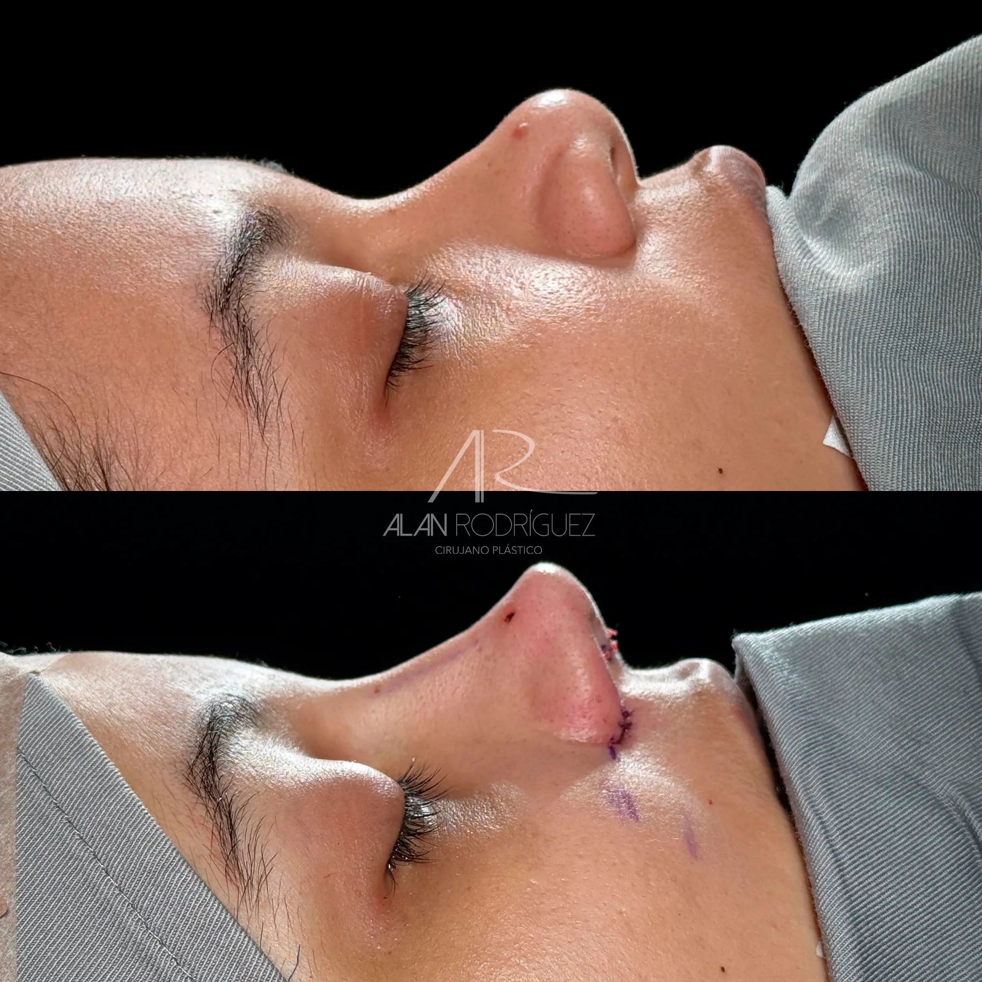 Rinoplastia Primaria con Injerto de Cartílago Costal: Aumento del Dorso