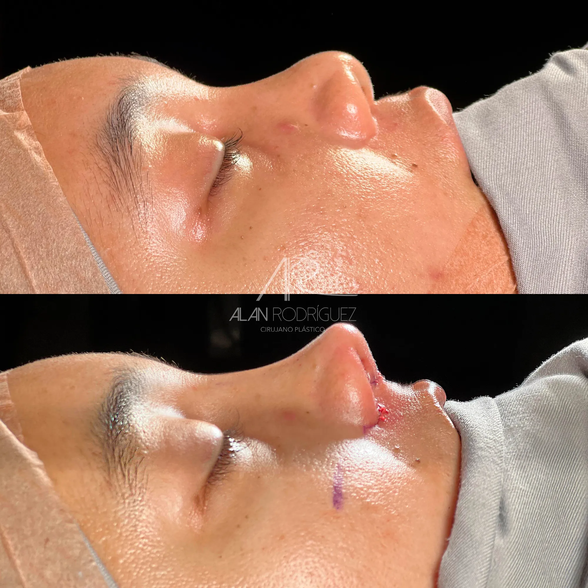 Rinoplastia Asistida por Ultrasonido con Injerto de Cartílago Costal