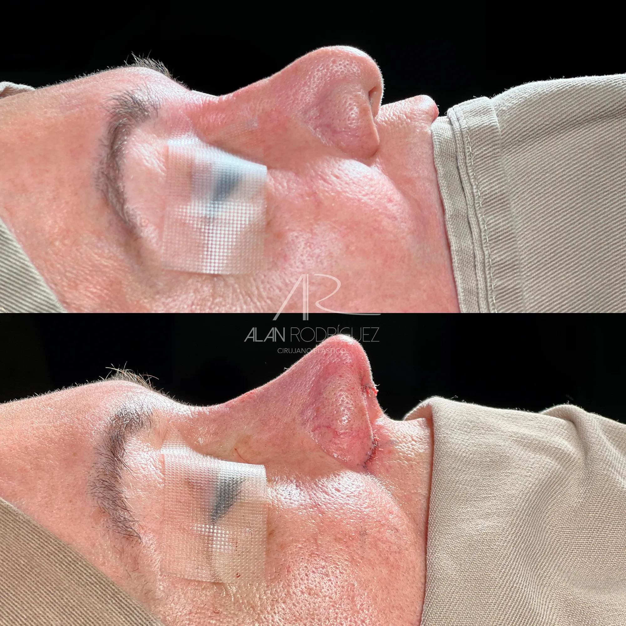 Rinoplastia Secundaria Reconstructiva: Caso de Alta Complejidad