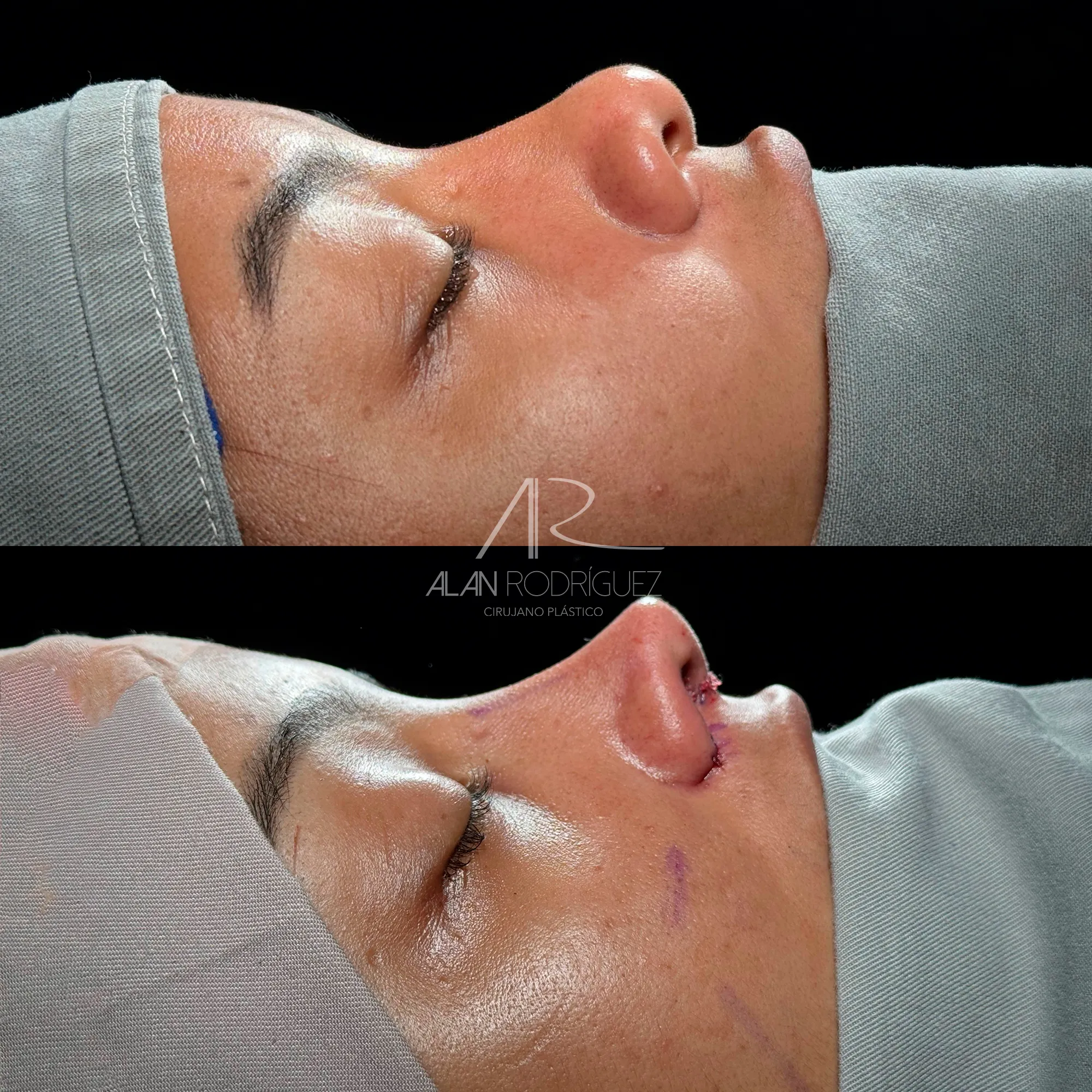 Rinoplastia con Ultrasonido: Nariz Perfilada y Delicada