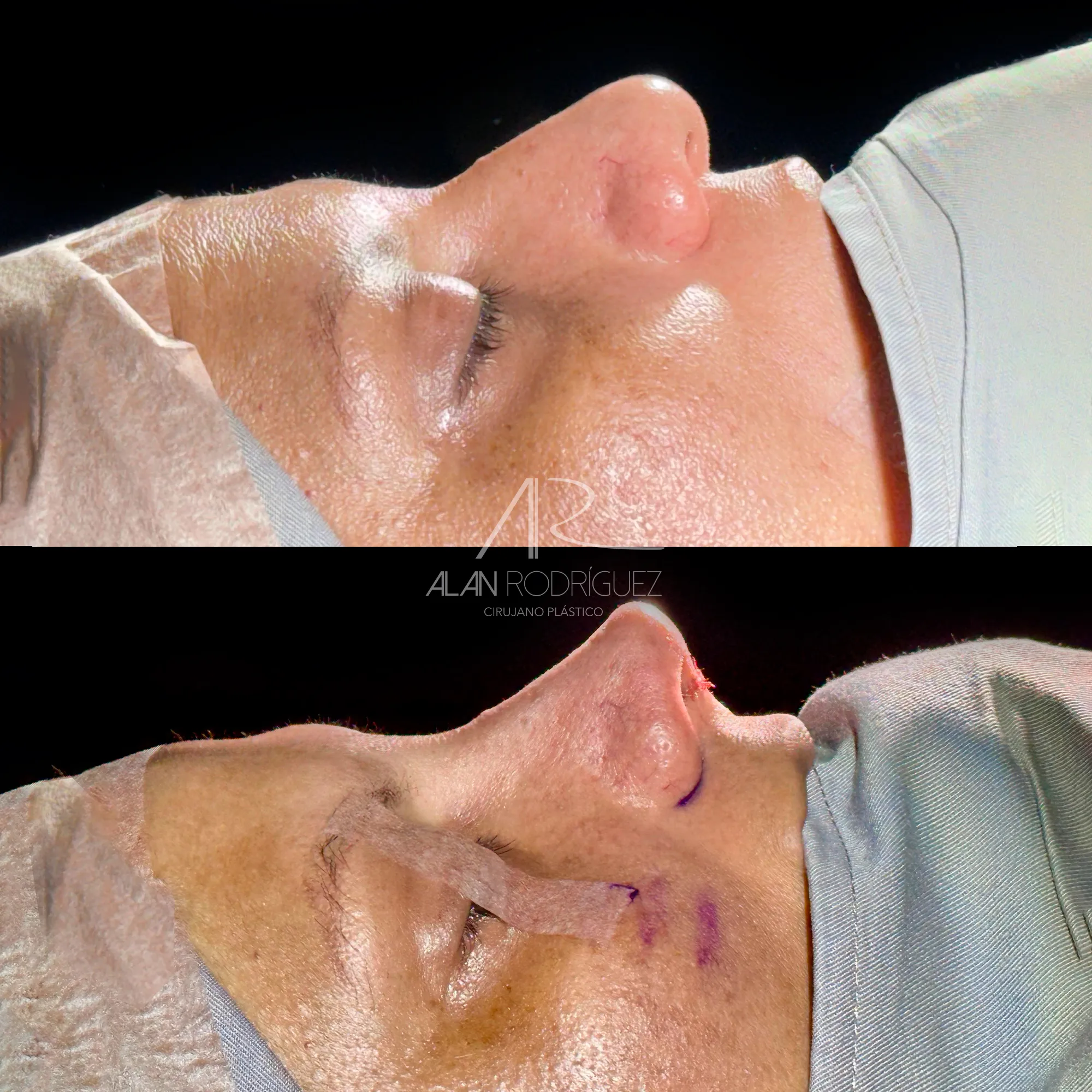 Rinoplastia Primaria: Corrección de Laterorrinia y Desvío Septal