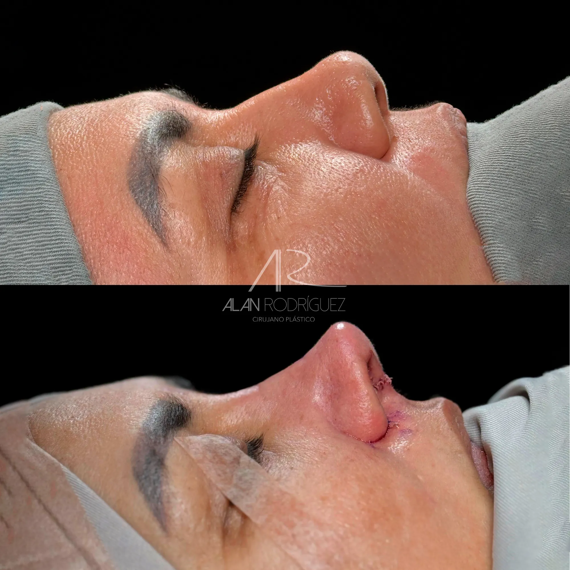 Rinoseptoplastia Asistida por Ultrasonido: Nariz Delicada y Funcional