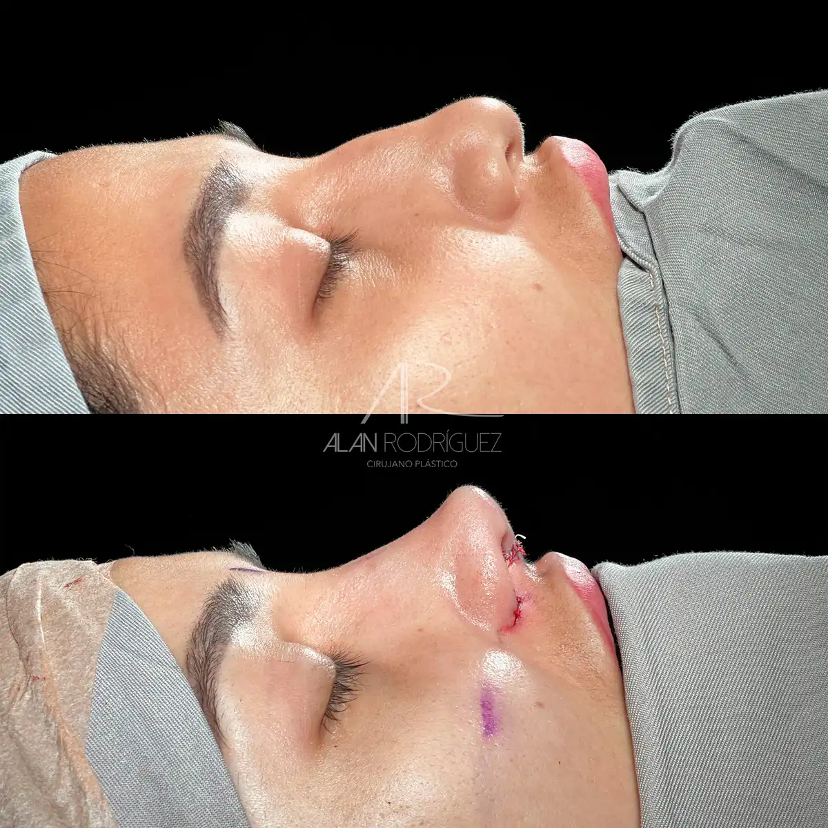 Rinoplastia ultrasónica en Barranquilla — caso 1, vista frontal, antes