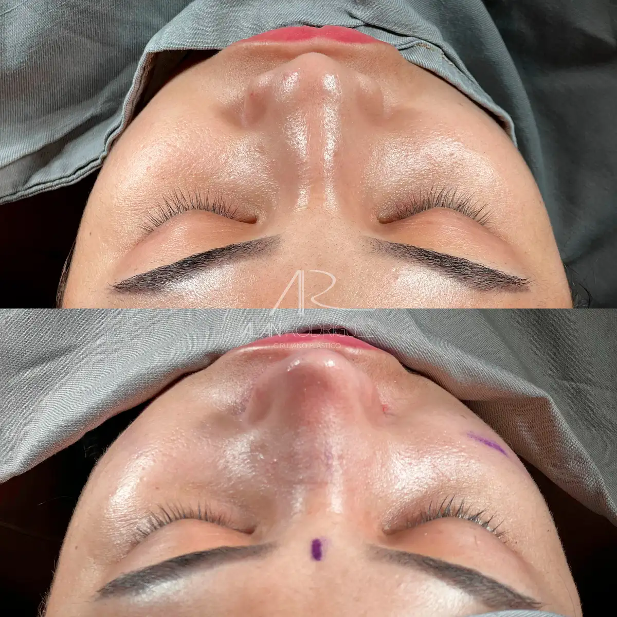 Rinoplastia ultrasónica en Barranquilla — caso 1, vista perfil, inmediatamente después