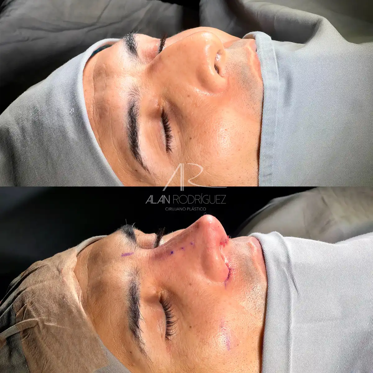 Rinoplastia ultrasónica en Barranquilla — caso 2, vista frontal, inmediatamente después