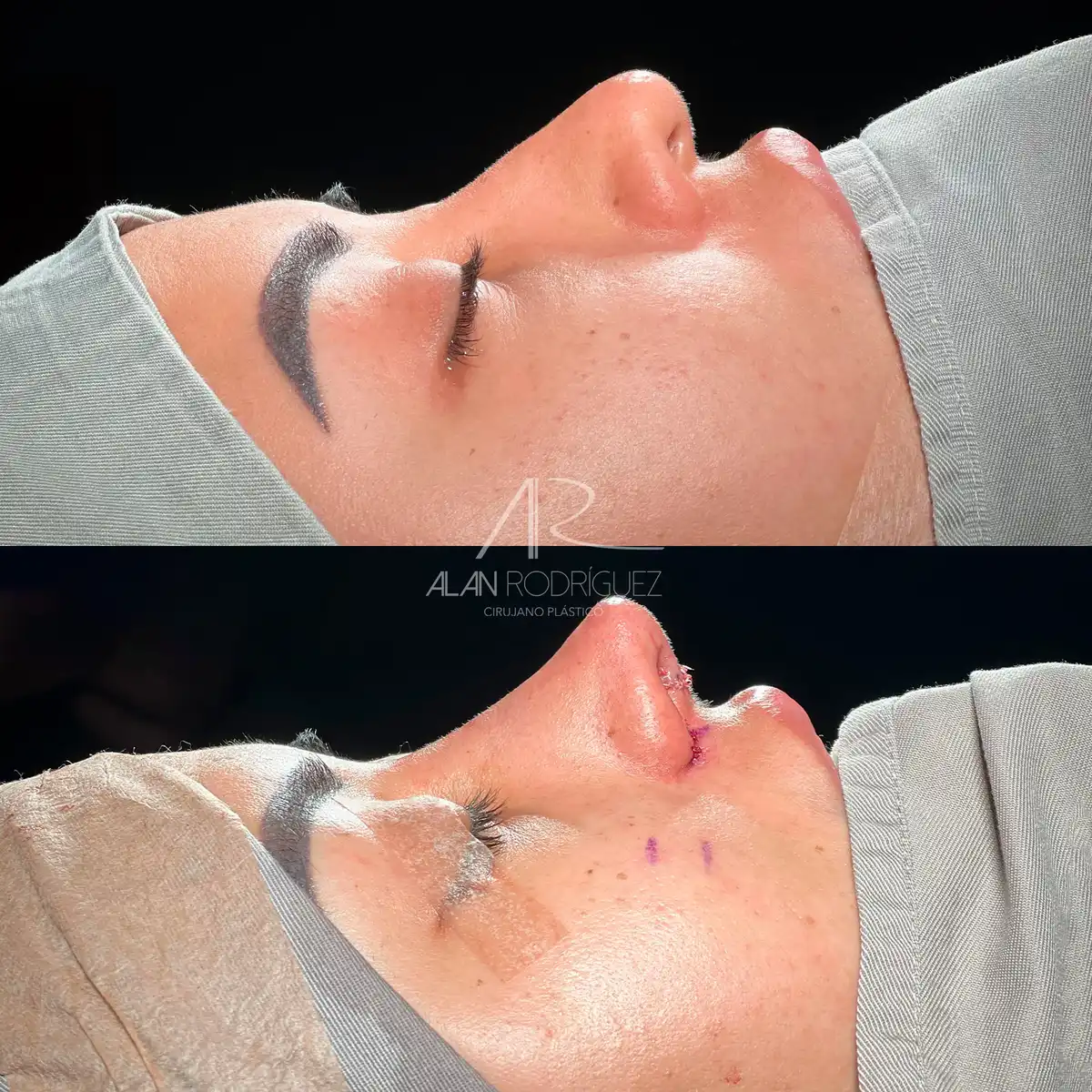 Rinoplastia ultrasónica en Barranquilla — caso 3, vista frontal, antes