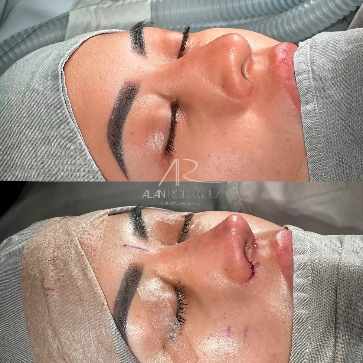 Rinoplastia ultrasónica en Barranquilla — caso 3, vista frontal, inmediatamente después