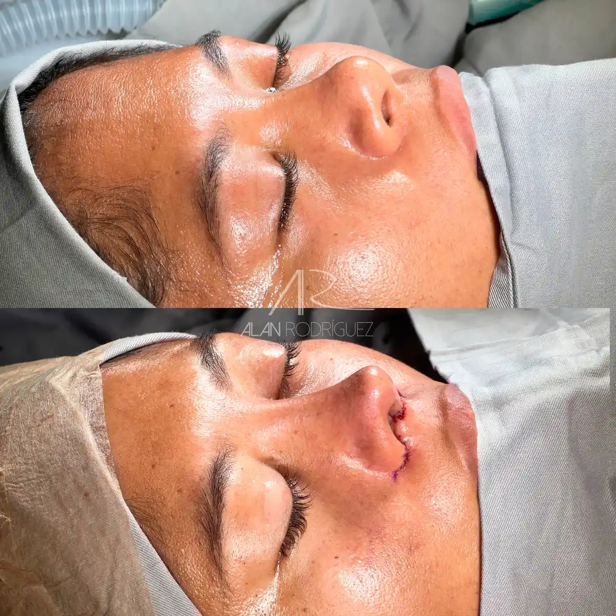 Rinoplastia ultrasónica en Barranquilla — caso 4, vista frontal, inmediatamente después