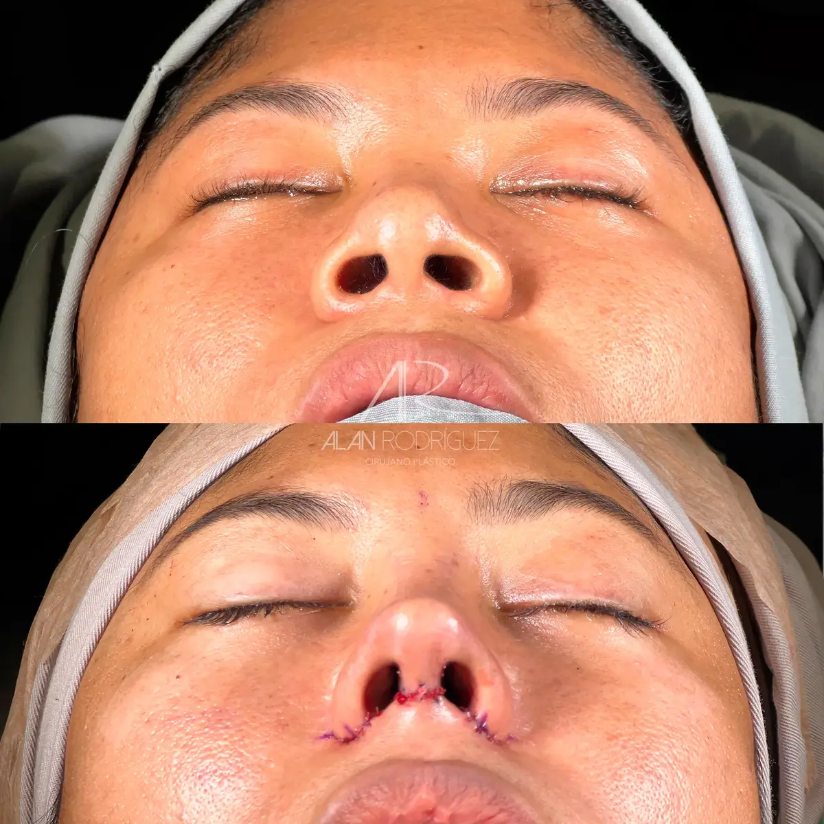 Rinoplastia ultrasónica en Barranquilla — caso 4, vista perfil, antes