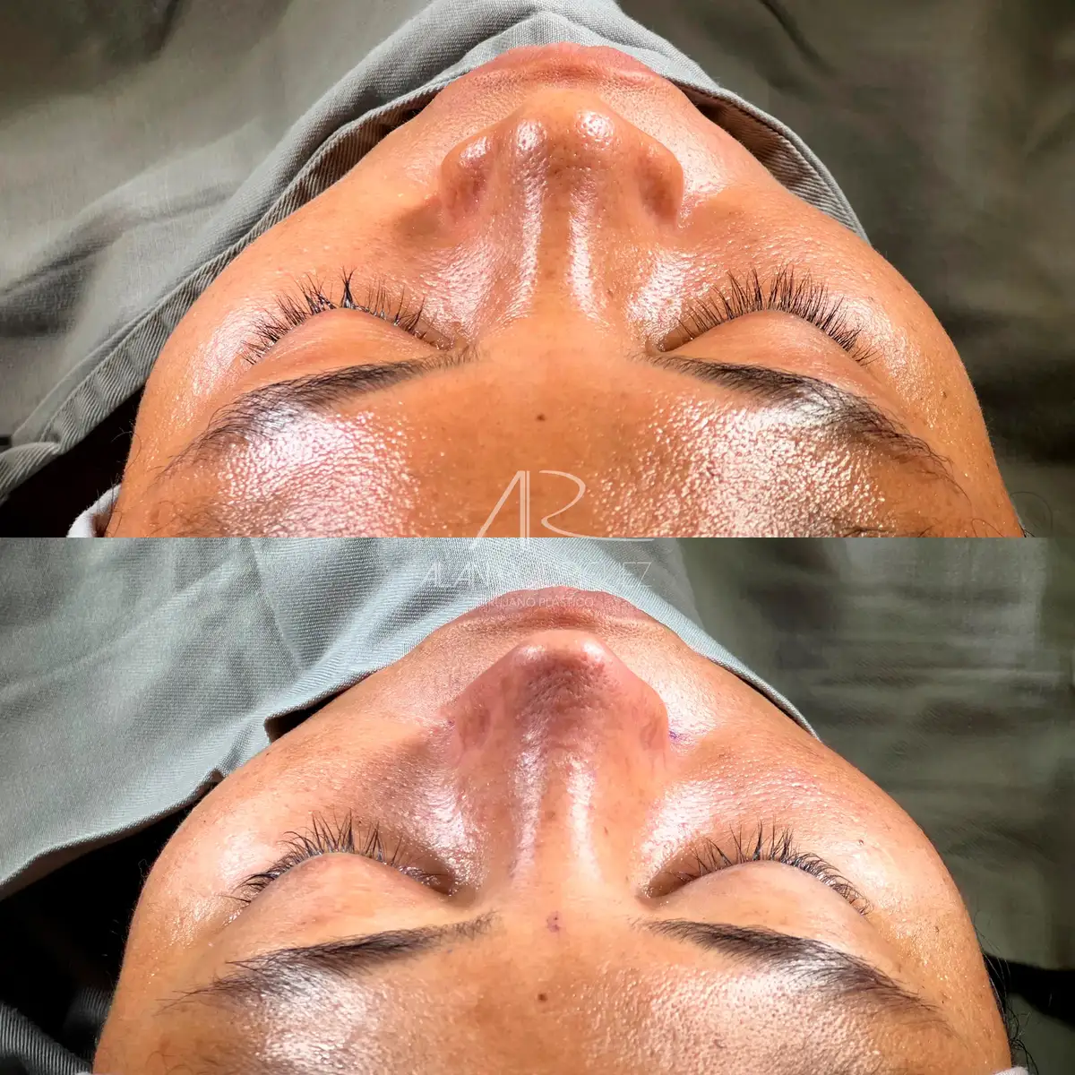 Rinoplastia ultrasónica en Barranquilla — caso 4, vista perfil, inmediatamente después