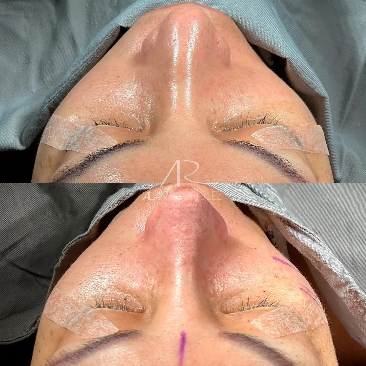 Rinoplastia ultrasónica en Barranquilla — caso 5, vista perfil, inmediatamente después