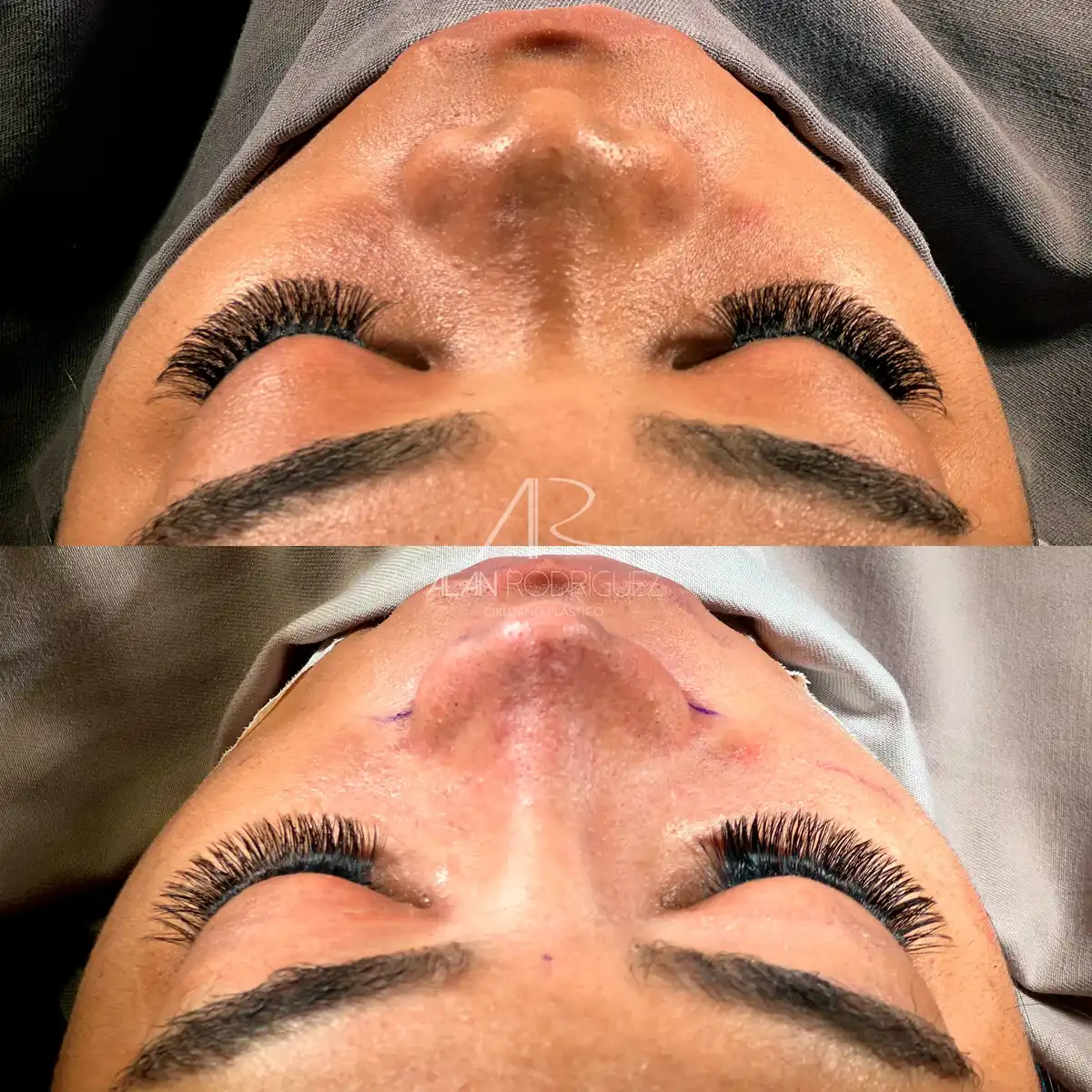 Rinoplastia ultrasónica en Barranquilla — caso 6, vista perfil, inmediatamente después