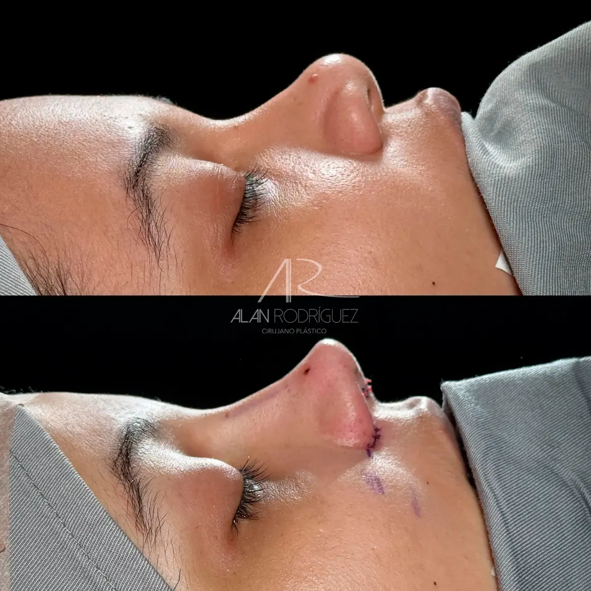 Rinoplastia ultrasónica en Barranquilla — caso 8, vista frontal, antes