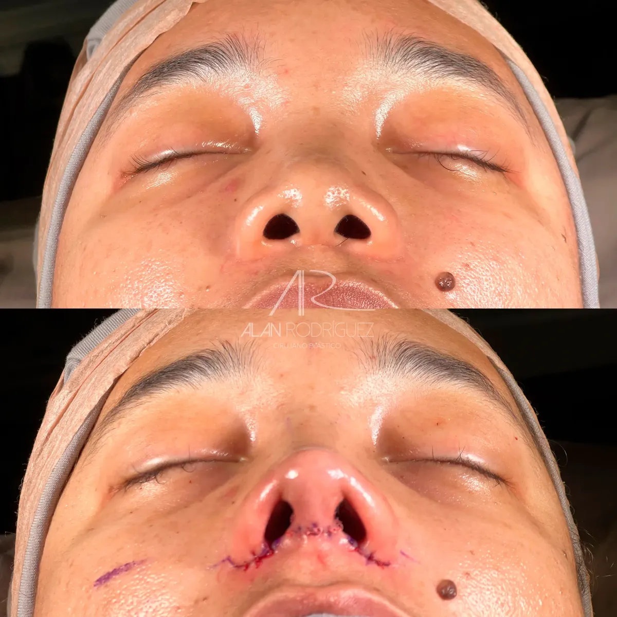 Rinoplastia ultrasónica en Barranquilla — caso 9, vista perfil, antes