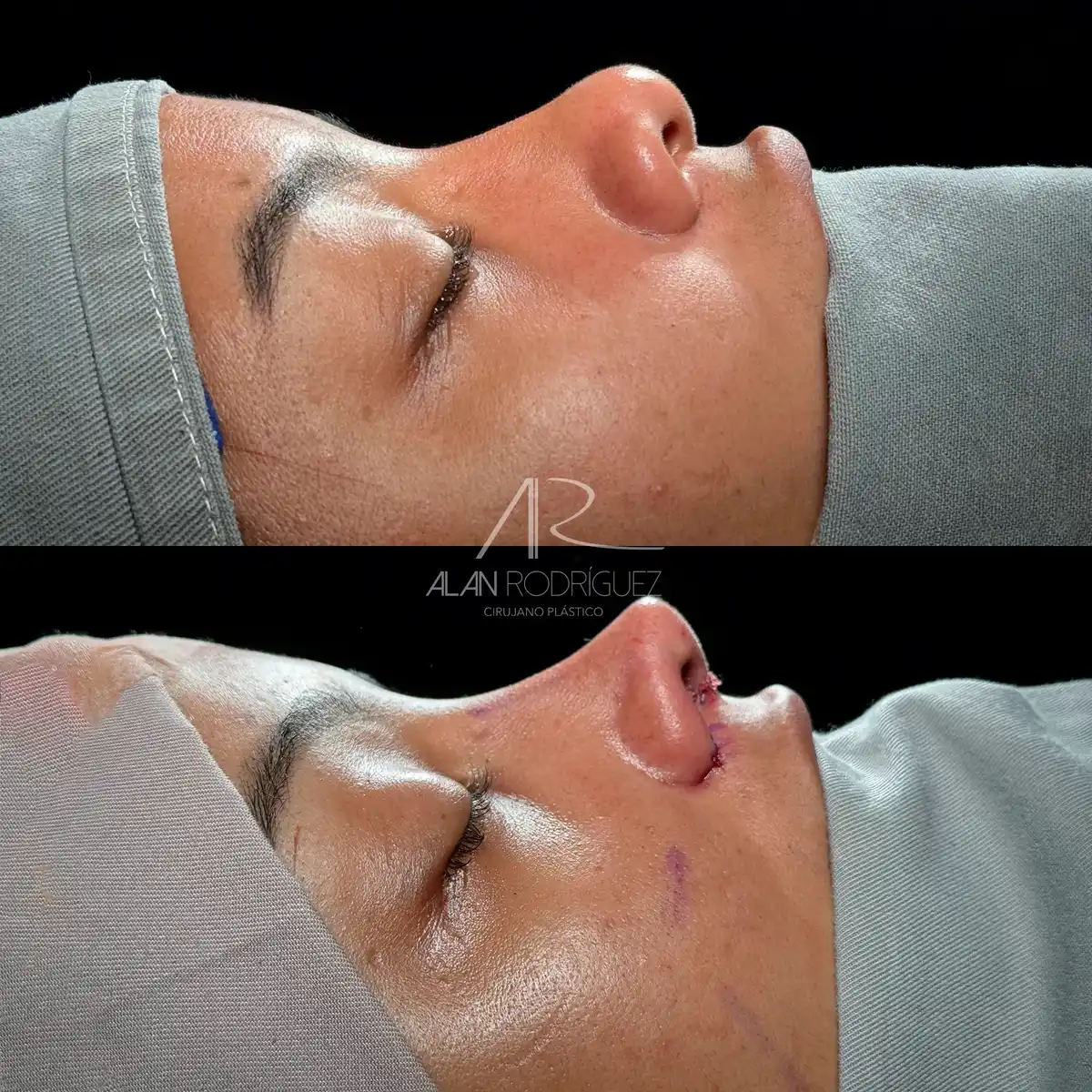 Rinoplastia ultrasónica en Barranquilla — caso 12, vista frontal, antes
