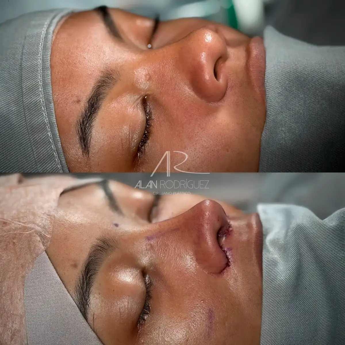 Rinoplastia ultrasónica en Barranquilla — caso 12, vista frontal, inmediatamente después