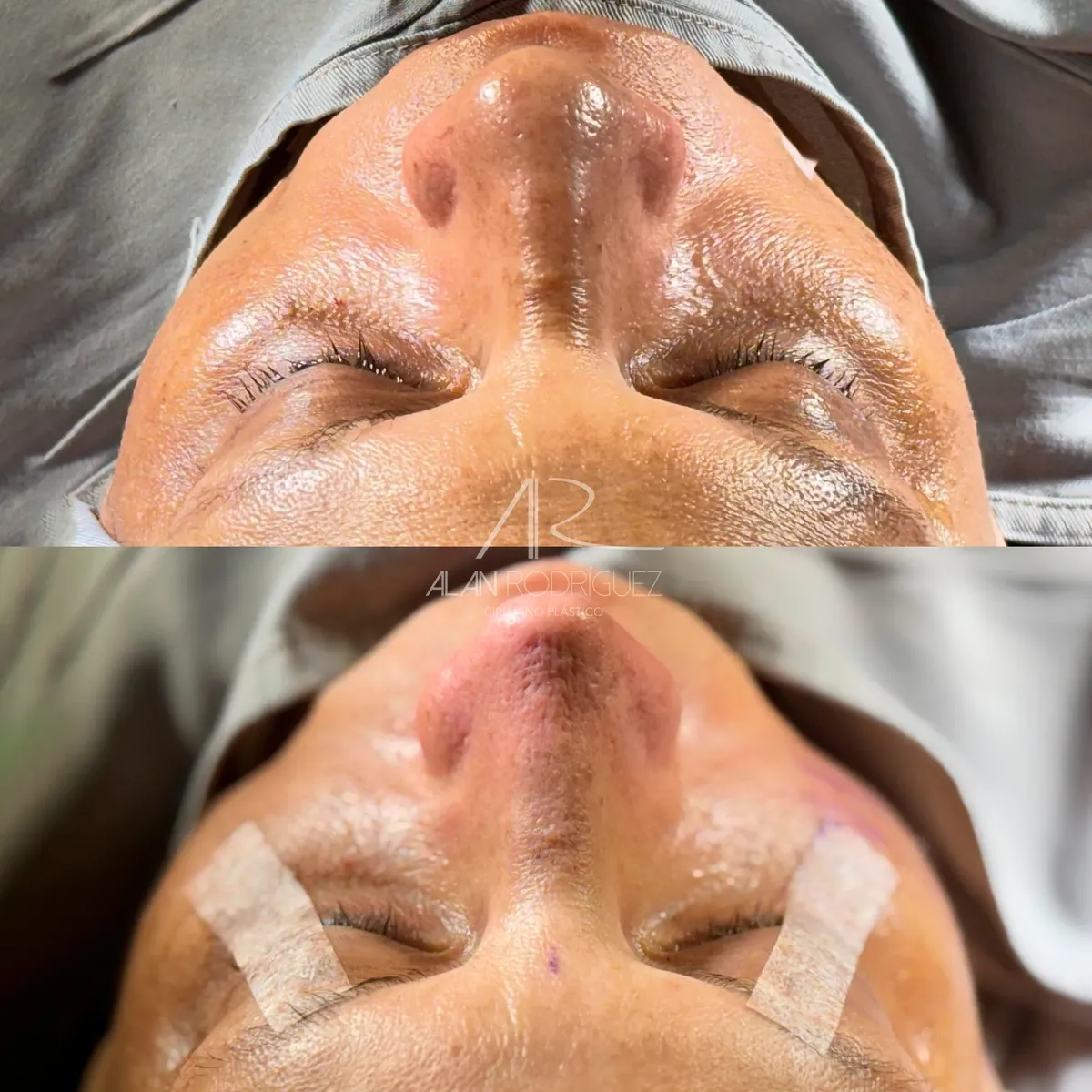 Rinoplastia ultrasónica en Barranquilla — caso 13, vista perfil, inmediatamente después