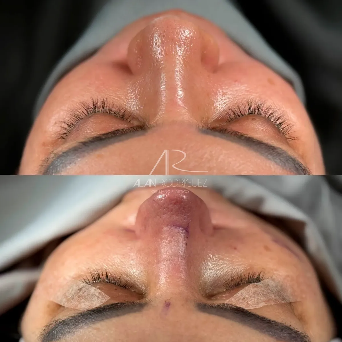 Rinoplastia ultrasónica en Barranquilla — caso 14, vista perfil, inmediatamente después